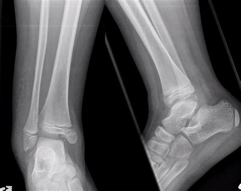 peds ankle x ray